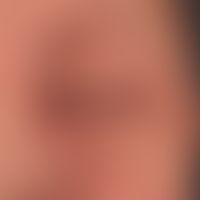 Airborne Contact Dermatitis:&nbsp;akute, flächenhafte, enorm juckende&nbsp;und brennende Dermatit...