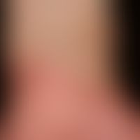 Psoriasis palmaris et plantaris (Plaquetyp):&nbsp;rote und schuppende, markant indurierte Plaques...