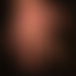 Psoriasis palmaris et plantaris (plaque-type): red and scaly, markedly indurated plaque covering ...