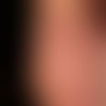 Psoriasis plantaris (plaque type): red, massively scaly, markedly indurated plaque on the sole of...