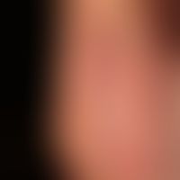 Psoriasis plantaris (Plaquetyp):&nbsp;rote, massiv schuppende, markant indurierte Plaque&nbsp;der...