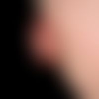 Karzinom kutanes:&nbsp;fortgeschrittenes, flächig ulzeriertes exophytisches Plattenpithelkarzinom .

