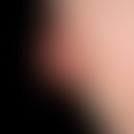 Squamous cell carcinoma of the skin: slowly growing, painless, broad-based nodule that has been w...