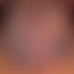 Malformationen,venöse :&nbsp;überweibgend vneöse Malformation mit großem, weichem, submukösem&nbs...
