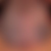 Malformationen,venöse :&nbsp;überweibgend vneöse Malformation mit großem, weichem, submukösem&nbs...