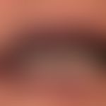 Malformationen, vaskuläre:&nbsp;gemischte venös/kapilläre Malformation mit ektatischen venösen un...