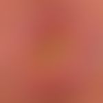 Merkelzell-Karzinom:&nbsp;uncharakteristischer zentral tief ulzerierter, plattenartiger Knoten. Z...