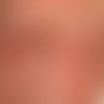Dermatitis, phototoxische: bereits in der Abheilungsphase sich befindliche akute&nbsp;Dermatitis ...