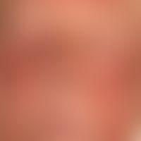 Dermatitis, phototoxische: bereits in der Abheilungsphase sich befindliche akute&nbsp;Dermatitis ...