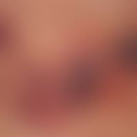 Angiokeratoma circumscriptum:&nbsp;seit Geburt bestehende vaskuläre Malformation, die in den letz...