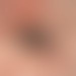 Angiosarcoma of the head and facial skin: the 69-year-old patient noticed this rapidly growing an...
