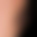 Angiosarcoma of the head and facial skin: the 69-year-old patient noticed this rapidly growing an...