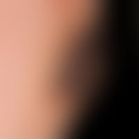 Angiosarcoma of the head and facial skin: the 69-year-old patient noticed this rapidly growing an...