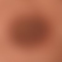 Keratosis areolae mammae naeviformis:&nbsp;chronisch stationäre, seit Jahren unveränderte, auf Br...