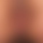 Acanthosis nigricans maligna: generalized infestation with acquired (since 1-2 years existing), h...