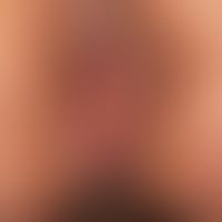 Acanthosis nigricans maligna:&nbsp; generalisierter Befall mit erworbenen (seit 1-2Jahren bestehe...