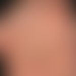 Akrokeratose&nbsp;paraneoplastische:&nbsp;Disseminierte, napfartige, braun-gelbliche, teils disse...