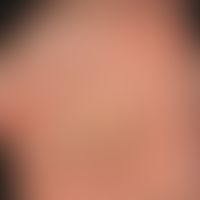 Akrokeratose&nbsp;paraneoplastische:&nbsp;Disseminierte, napfartige, braun-gelbliche, teils disse...