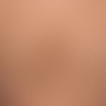Differential diagnosis - Acrokeratosis paraneoplastic: Disseminated, cup-like brown, partly singl...