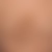 Differential diagnosis - Acrokeratosis paraneoplastic: Disseminated, cup-like brown, partly singl...