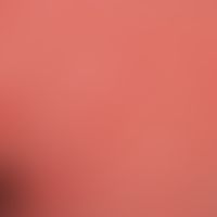 Drug exanthema maculo-papular: extensive, generalized, symmetrical, severe itching (and painful; ...