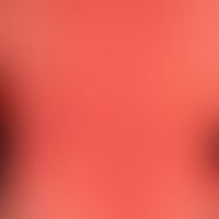 Erythrodermia (erythrodermal drug exanthema): erythrodermal exanthema that has been present for a...