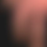Pigments of the skin: nicotine discoloration of skin and nails of the fingers.
