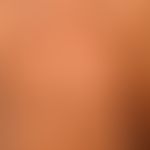 Pityriasis versicolor alba:&nbsp;Depigmentierungen nach bereits abgeheilter Pilz-Infektion. Negat...