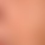 Lichtalterung der Haut: scheckige Haut mit kleinherdigen Hyperpigmentierungen.
