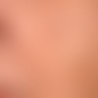 Light ageing of the skin: chequered skin with small hyperpigmentations.
