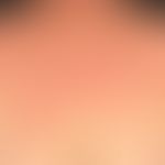 Extrinsic atopiceczema: eminently chronic, somewhat asymmetrical eczema with blurred, itchy, red,...