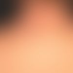 extrinsic atopic dermatitis: eminently chronic, somewhat asymmetrical eczema with blurred, itchy,...