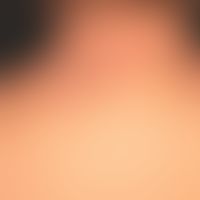 Extrinsische atopische Dermatitis: eminent&nbsp;chronisches, etwas&nbsp; asymmetrisches Ekzembild...