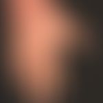 Hand eczema atopic: long-term atopic eczema with variable course; the skin on both backs of the h...