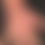 Hand eczema atopic: long-term atopic eczema with variable course; the skin on both backs of the h...