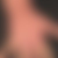 Hand eczema atopic: long-term atopic eczema with variable course; the skin on both backs of the h...