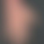 Hand eczema atopic: previously known atopic eczema with variable course; the skin lesions on both...