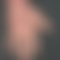 Hand eczema atopic: previously known atopic eczema with variable course; the skin lesions on both...