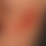 Pyoderma (overview): therapy-resistant impetigo with erosive, weeping, red, itchy papules and pla...