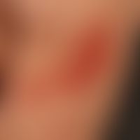 Pyodermie (Übersicht): therapieresistente Impetigo mit erosiver, nässenden , roten, juckenden&nbs...