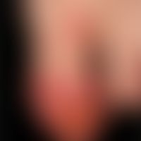 Acrodermatitis continua suppurativa: seit&nbsp;Jahren bestehende, ausgeprägte, lokaltherapeutisch...
