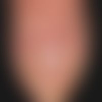 psoriasis of the nails. severe onychodystrophy with wave-like transverse ligament with simultaneo...