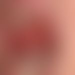 Pemphigus vulgaris: flächenhafte, schmerzende&nbsp;Erosionen am weichen und harten Gaumen
