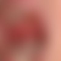 Pemphigus vulgaris: flächenhafte, schmerzende&nbsp;Erosionen am weichen und harten Gaumen
