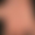 Ekzem, hyperkeratotisch-rhagadiformes Handekzem. Übersichtsaufnahme: Multiple, vor 3 Jahren erstm...