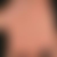 Ekzem, hyperkeratotisch-rhagadiformes Handekzem. Übersichtsaufnahme: Multiple, vor 3 Jahren erstm...