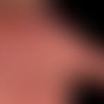 Dyshidrotische Dermatitis: Zustand nach großblasigem Schub des dyshidrotischen Ekzems.

