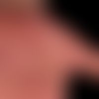 Dyshidrotische Dermatitis: Zustand nach großblasigem Schub des dyshidrotischen Ekzems.
