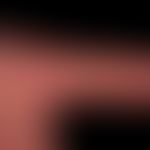 Dyshidrotische Dermatitis: Zustand nach großblasigem Schub des dyshidrotischen Ekzems.
