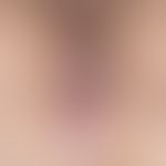 Lichen sclerosus with perianal infestation, vulva free, typical is the scahrf limited marginal zo...